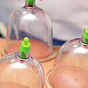 cupping_therapy-image-education